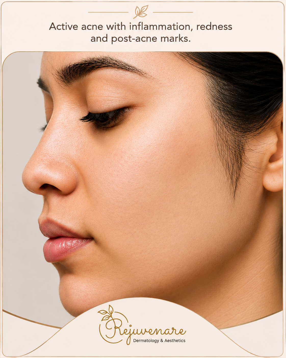 Acne treatment — after