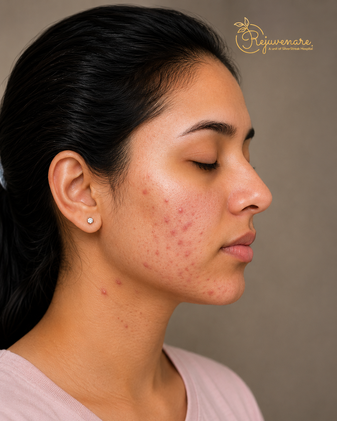 Hormonal acne — before treatment